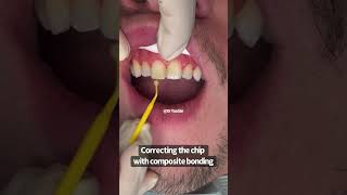 Fixing a chipped front tooth  composite bonding  Cosmetic Dentist Dr Yazdan [upl. by Emie]