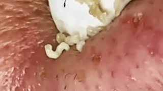 WOOW  BEAUTY OF SQUEEZE😨 BLACKHEADS REMOVAL FROM THE NOSE 2 relaxing blackheads [upl. by Edia]