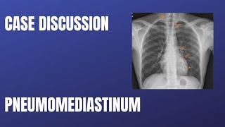 Case Discussion  Pneumomediastinum [upl. by Aryl]