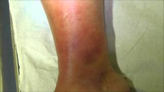 A case of tibial cellulitis before and 24 hours after treatment with antibiotics [upl. by Alaric]