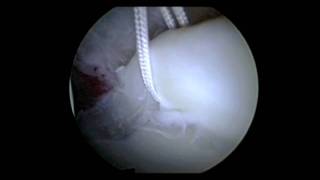 Hip Arthroscopy Labral Repair Surgery  Repair Torn Hip Labrum  Dr David J King [upl. by Ahsemrak583]