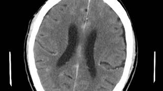 CNS C6 Leptomeningeal enhancement [upl. by Nessi447]