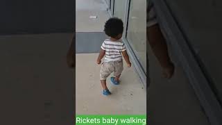 Rickets baby walking [upl. by Alicirp40]