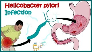 Helicobacter Pylori Infection  Gastric ulcer  Causes Signs and Symptoms Diagnosis and Treatment [upl. by Sugar]