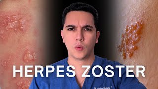 Culebrilla Herpes zoster ¿Qué sucede si se une la cabeza con la cola  Dr William Guerrero [upl. by Nedroj]