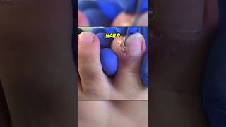 Satisfying Ingrown Toenail Removal satisfying shortfeed [upl. by Margalo]