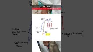 Peripheral Inserted Central Catheter PICC neetpg inicet [upl. by Tterrej]