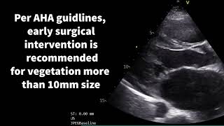 Cardiac vegetations in focus [upl. by Koorb]