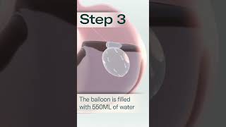 Allurion Gastric Balloon  A Simple Solution to Lasting Weight Loss [upl. by Bruis772]