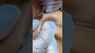 😬 Grosse extraction choc acne blackheads blackheadremoval [upl. by Assenat]