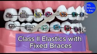 How to use class II elastics with Fixed Braces [upl. by Horvitz]