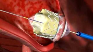 TransApical Percutaneous Valve Animation [upl. by Azarcon90]