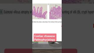 Coeliac diseaese pathophysiology شرح بالعربي [upl. by Gersham]