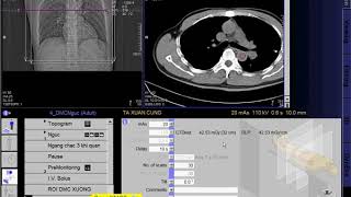 CT Scan angiography of the thoracic aorta SIEMEN  CLVT Động mạch chủ ngực [upl. by Verge]