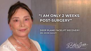 Louisa  Deep Plane Facelift Patient of Dr Kevin Sadati Discusses Her Recovery [upl. by Lurette903]