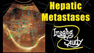 Hepatic Metastases From Breast Carcinoma  Ultrasound  Case 117 [upl. by Airamzul]