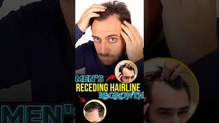 Receding Hairline regrowth derma roller hair mensgrooming [upl. by Aiciruam229]