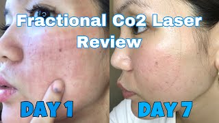 FRACTIONAL CO2 LASER AFTER TREATMENT REVIEW  DAY 1 TO DAY 7  VLOG 5 [upl. by Hayouqes418]