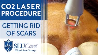 CO2 Laser Resurfacing Treatment For Getting Rid of Scars  Full Procedure [upl. by Trojan]