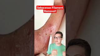 Major BLACKHEAD REMOVAL  Popping Sebaceous Filaments shorts [upl. by Nollaf]