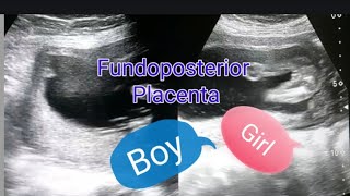 Fundoposterior placenta  Anterior placenta means baby boy  Posterior placenta means baby girl [upl. by Teague]