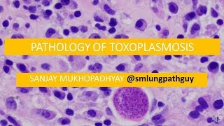 Pathology of toxoplasmosis [upl. by Ennayehc]