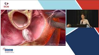 Why PFO Closure Is an Exciting Therapy [upl. by Bennet331]