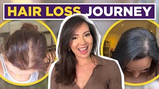 HAIR LOSS TREATMENT FOR WOMEN MY FEMALE HAIR LOSS JOURNEY  TIPS ON HAIR LOSS [upl. by Roma849]