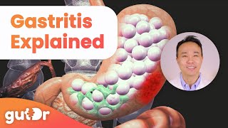 What is Gastritis  The GutDr Explains 3D Gut Animation [upl. by Winfred]