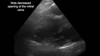 Left Ventricular Apical Thrombus [upl. by Sapers]