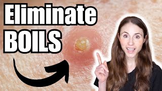 How To Get Rid Of Boils  Dermatologist Tips [upl. by Eicram]