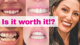 INVISALIGN UPDATE REVIEW  REFINEMENTS BEFORE amp AFTER 2020 [upl. by Stilwell]