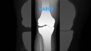 Varus  Valgus Deformities of the Knee on XRay kneepain radiology anatomy [upl. by Erdnaxela]