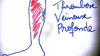 SmartNEasy  Thrombose veineuse profonde  Dr Astuce [upl. by Whitver]