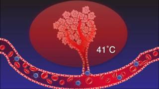 How Hyperthermia jumpstarts the Immune Modulation Effect to Fight Cancer [upl. by Bria]