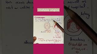 Unstable angina stable angina variant angina angina medical [upl. by Derfniw]