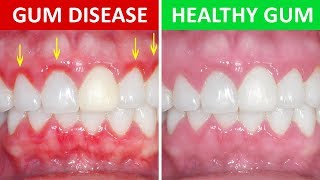 How to Get Rid of Gingivitis at Home Gum Disease [upl. by Leann]