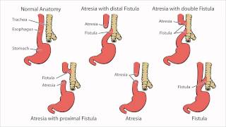 Esophageal Atresia  What is Esophageal Atresia [upl. by Anin]