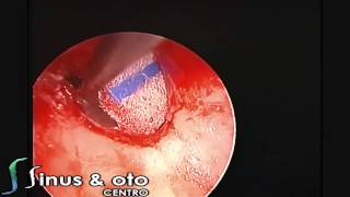 Keratosis Obturans Endoscopic Surgery [upl. by Helfant]