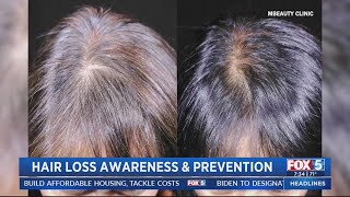 Hair Loss Awareness and Prevention [upl. by Darnall]