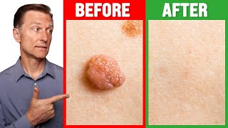 How to Rid Skin Tags and Warts Within 24 Hours  Dr Berg on Skin Tag Removal [upl. by Aileme]