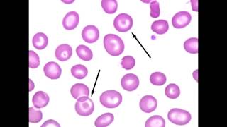 Teardrop Cell Dacrocyte amp Target Cell Codocytes [upl. by Minda]