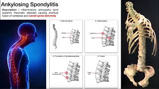 Ankylosing Spondylitis  Mechanism Risk Factors amp SignsSymptoms [upl. by Eeltrebor19]