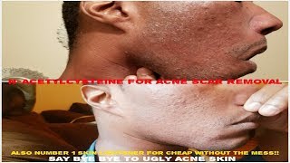 Nacetylcysteine How to Remove Ugly Acne Scars and Skin Wrinkles [upl. by Narba]