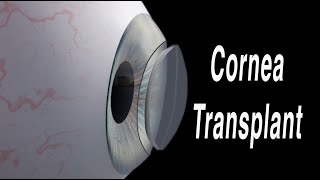 Cornea Transplant Penetrating Keratoplasty [upl. by Eidaj66]