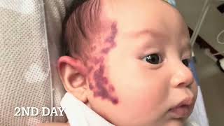 Newborn Port Wine Stain Treatment Progress [upl. by Descombes887]