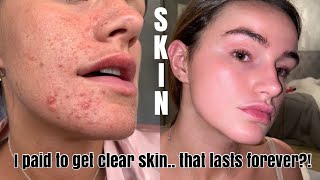 SKIN JOURNEY  I went on roaccutane private health care how much I paid  Syd and Ell [upl. by Haidebez850]