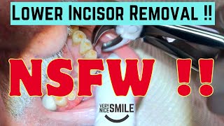 Extracting lower incisor teeth [upl. by Arjun765]