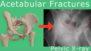 Acetabular Fractures  Xrays explained [upl. by Tabbatha]