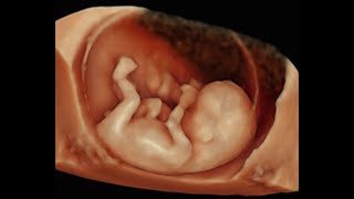 How to Perform 3D Scan of the Baby at 12 Weeks of Pregnancy [upl. by Ashling]